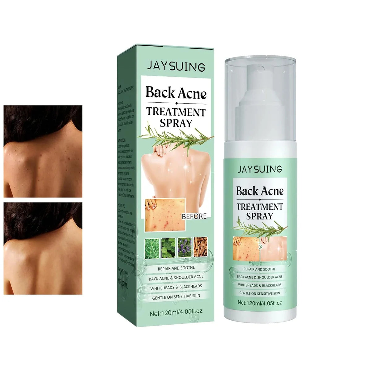 Back Acne Treatment Spray